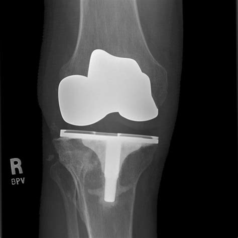 Radiograph After Orif Of The Tibial Plateau Fracture In The Same