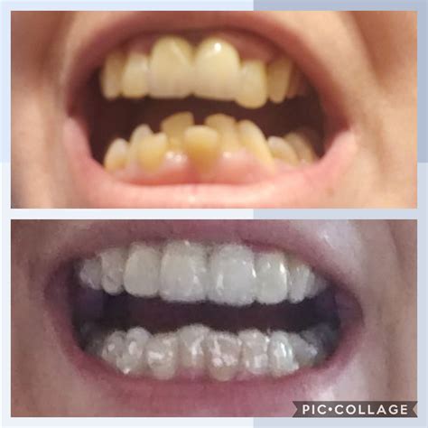 6 Months Into My Invisalign Journey 2 More Months To Go Rinvisalign