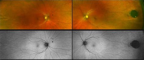 Congenital Hypertrophy Of The Retinal Pigment Epithelium Retina Image
