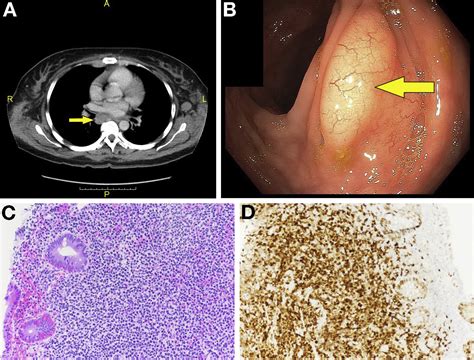 Mantle Cell Lymphoma Presenting As Lymphomatous Polyposis Clinical
