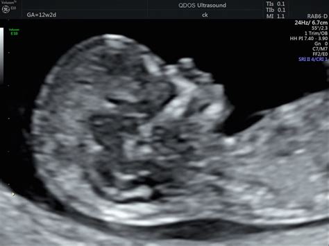 It looks like a small black hole. 12 Week Scan Perth | Pregnancy Ultrasound at 12 weeks ...