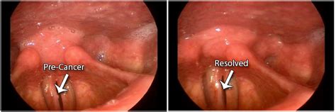But thyroid cancer tends to develop slowly and there may not be any symptoms at first. Nodules On The Throat - Black Blonde Pussy