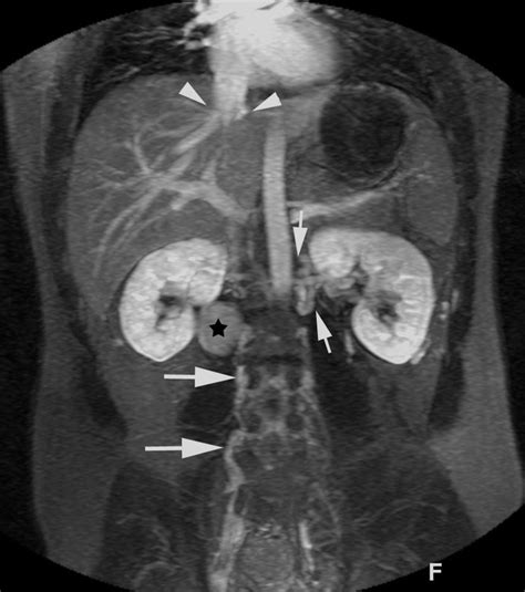 Interruption Of The Inferior Vena Cava With Aneurysm Of The Right Renal
