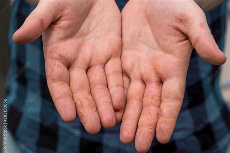 Dyshidrotic Eczema Hands Of Patient Concept Of Health Care Foto De
