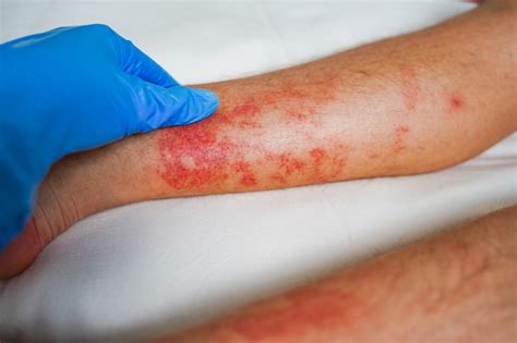 Premium Photo Eczema Skin Disease On The Legs Itchy Red Rashes And Spots