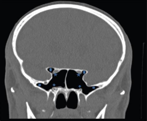 Uncommon Optic Nerve Course In The Sphenoid Sinus Dalati Ha Jabbr Ms