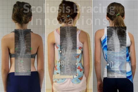 Spinal Braces Scoliosis Bracing Innovations