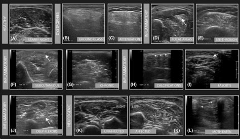 Muscle Ultrasound Present State And Future Opportunities Wijntjes