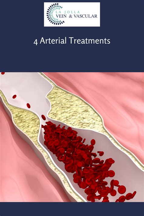Vein And Vascular Treatment Arterial Treatments