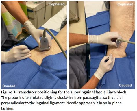 How I Do It Suprainguinal Fascia Iliaca Block