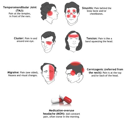 Learn Different Types Of Headaches Headache Types Migraines My Xxx
