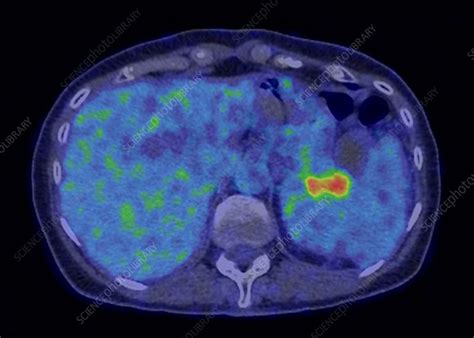 Pancreatic Cancer Ct Pet Scan Stock Image C0482983 Science