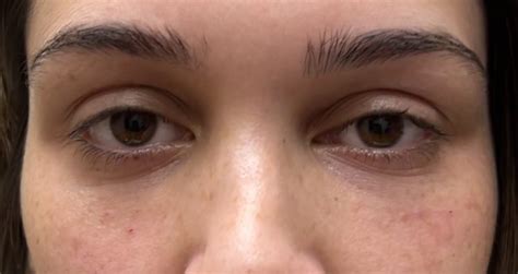 4 Eyelid Filler Before And After Photos Dallas Plano Texas Cosmetic