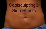 Images of Coolsculpting Side Effects Long Term
