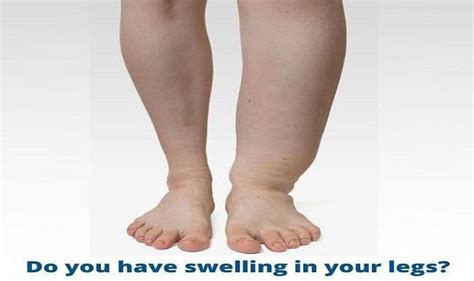Diabetic Oedema Here Is How To Get Rid Of Swollen Feet Due To The