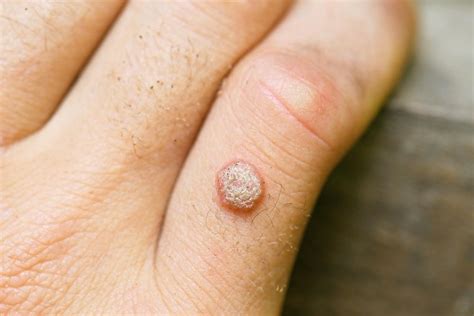 How To Get Rid Of A Wart For Good Northstar Dermatology Dermatology