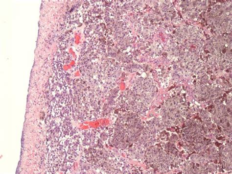 Pathology Outlines Nodular Melanoma