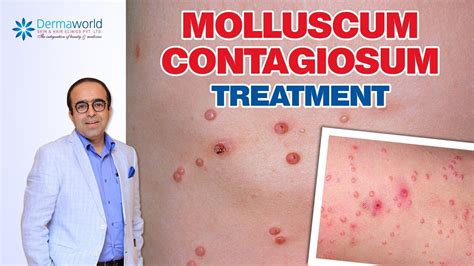 Molluscum Contagiosum Treatment Dr Rohit Batra Youtube