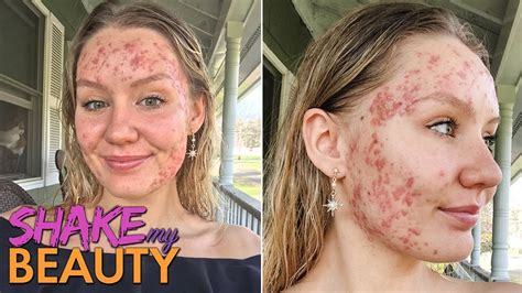 My Acne Became A Monster At 20 Shake My Beauty Youtube