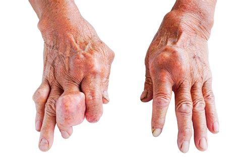 Dna Moczanowa Artretyzm Podagra Jakie S Przyczyny Objawy I Metody
