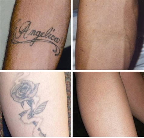 How much does tattoo removal cost? Tattoo Removal - Exhale Body Rejuvenation