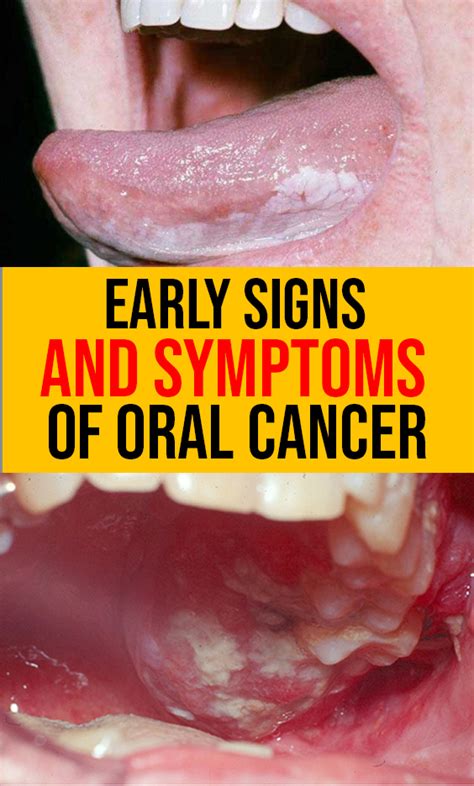 Warning Signs Of Oral Cancer Are You At Risk Medical Daily