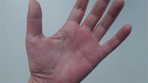 Itchy Rash On Palms Of Hands Pictures Photos