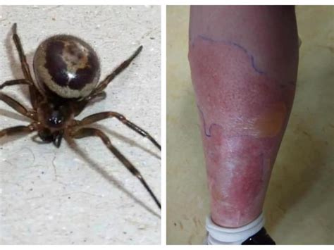 Woman Hospitalised For A Week After False Widow Spider Bite Leinster Express