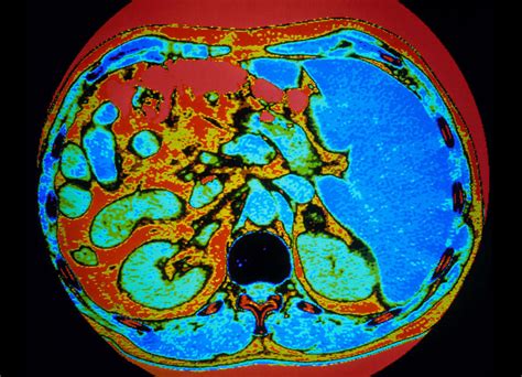 Ct Scan Of Human Adrenal Gland Photograph By Gcascience Photo Library