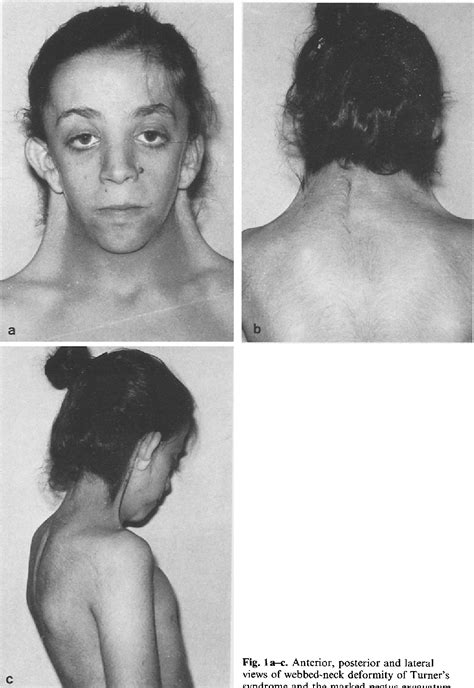 Figure 3 From Correction Of Webbed Neck Deformity In Turner S Syndrome