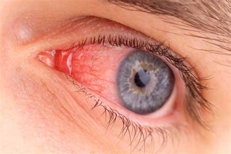 Stop Eye Infections Causes Treatment