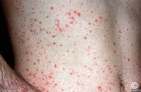 Guttate Psoriasis