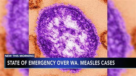 Measles Outbreak Grows In Northwest Us 31 Cases Reported Abc30 Fresno