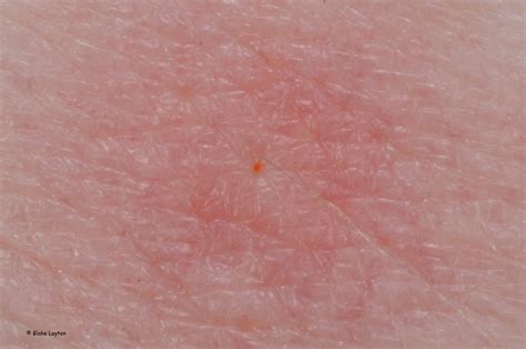 Tiny Pinpoint Red Dots On Skin After Sunburn Jambasta