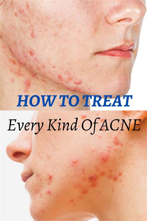How To Treat Every Kind Of Acne Face Acne Bad Acne Acne Skin