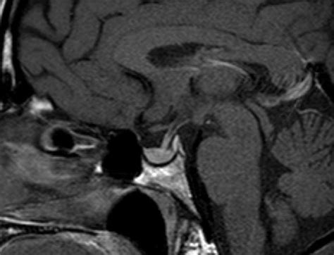 Normal Pituitary Gland Sagittal T Weighted Image Shows Normal My XXX