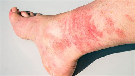 Naknek Infravörös Csoda Skin Rash On Legs Vezérlő Kicsomagolás Figyeljük