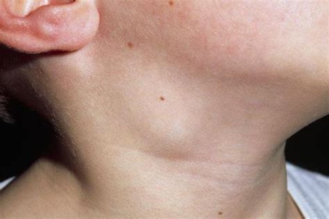 Razones Principales Para Ganglios Linfáticos Inflamados En El Cuello