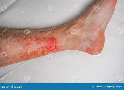 Eczema Skin Disease On The Legs Itchy Red Rashes And Spots Stock Photo