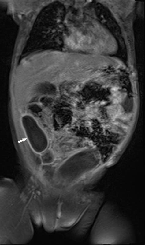 Infected Enteric Duplication Cyst Bmj Case Reports