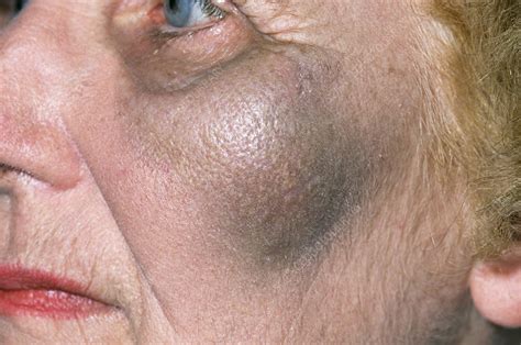 Bruise On Cheek Stock Image M3301079 Science Photo Library
