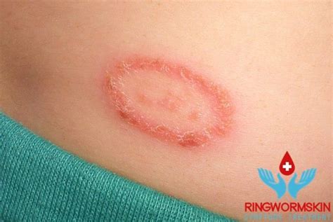 Treat Ringworm Easy And Fast With Bleach Homemadeacnetreatment