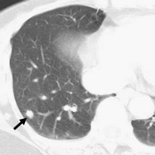 PET CT Scan Shows One Subpleural Nodule At The Right Middle Lobe With Download Scientific