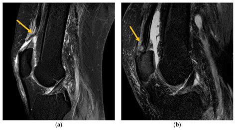 JPM Free Full Text Quadriceps Tendon Ruptures In Middle Aged To