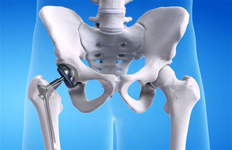 TOTAL HIP REPLACEMENT