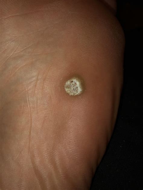 What Is This Strange Circle Of Dry Skin On My Foot Rmedical