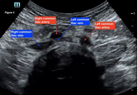 A Case Report Of May Thurner Syndrome Identified On Abdominal