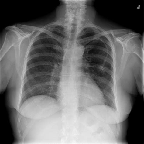 Four Examples Of The Chestx Ray14 Dataset Which Consists Of 112120