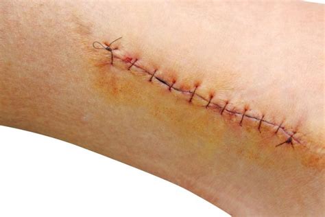 Got Stitches Herere 8 Ways To Heal Them Faster Just