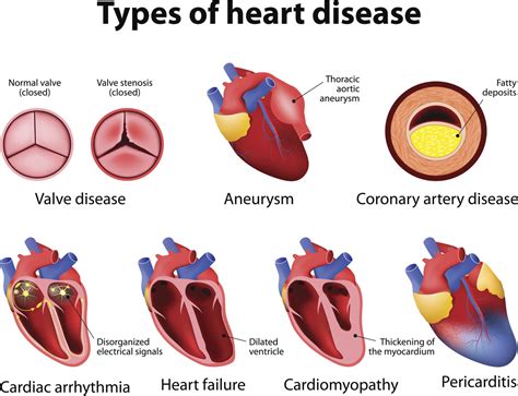 Causes Of Pericarditis Circulatory System And Disease